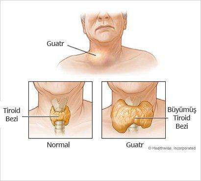Tiroid (Guatr) Hastalıkları